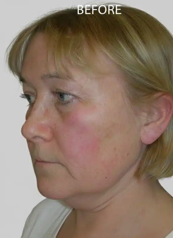 results-before